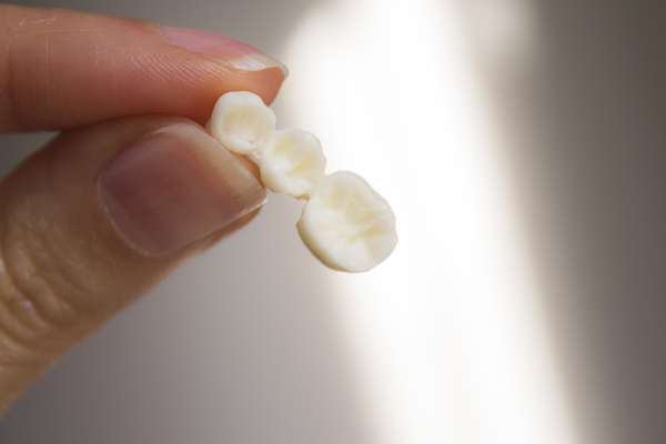 Bridges vs. Dental Implants: Which Is Better from Brede Ciapciak Dental in Needham, MA
