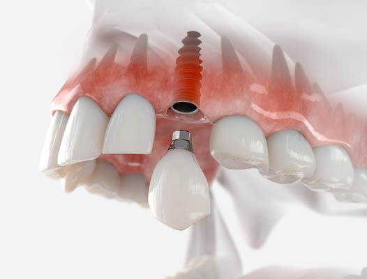 Dental Implant Needham, MA