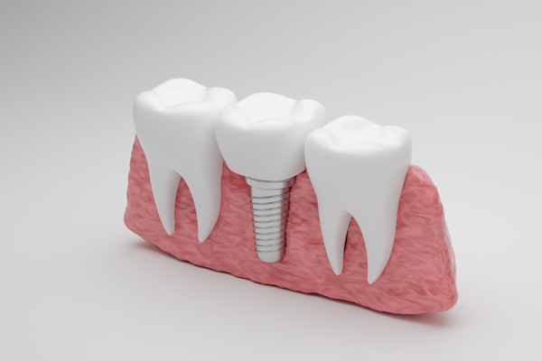 How To Know You Are A Candidate For Dental Implants