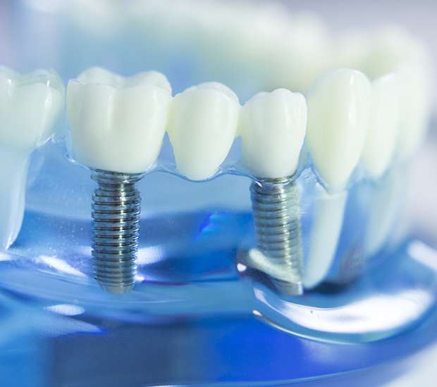 Needham Dental Implants