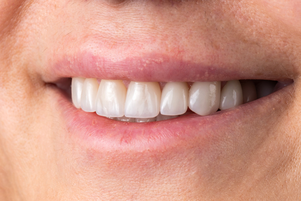 Overdentures Supported By Dental Implants