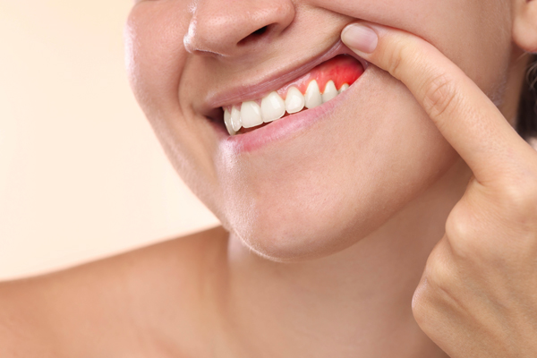 Gum Disease Treatment: Stages, Best Therapies, And How To Prevent Its Return