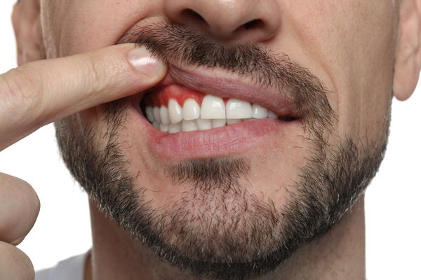 Common Questions About Gum Disease Treatment From A Periodontist