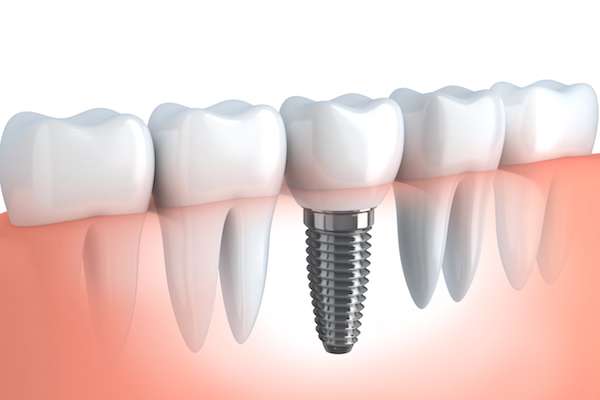 Your Ultimate Guide to Getting Dental Implants from Brede Ciapciak Dental in Needham, MA